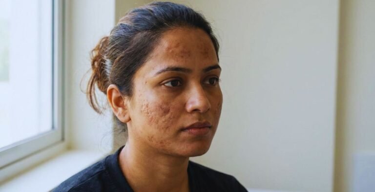 Acne - Pigmentation भारत में मुंहासे और पिग्मेंटेशन क्यों है बड़ी समस्या ?